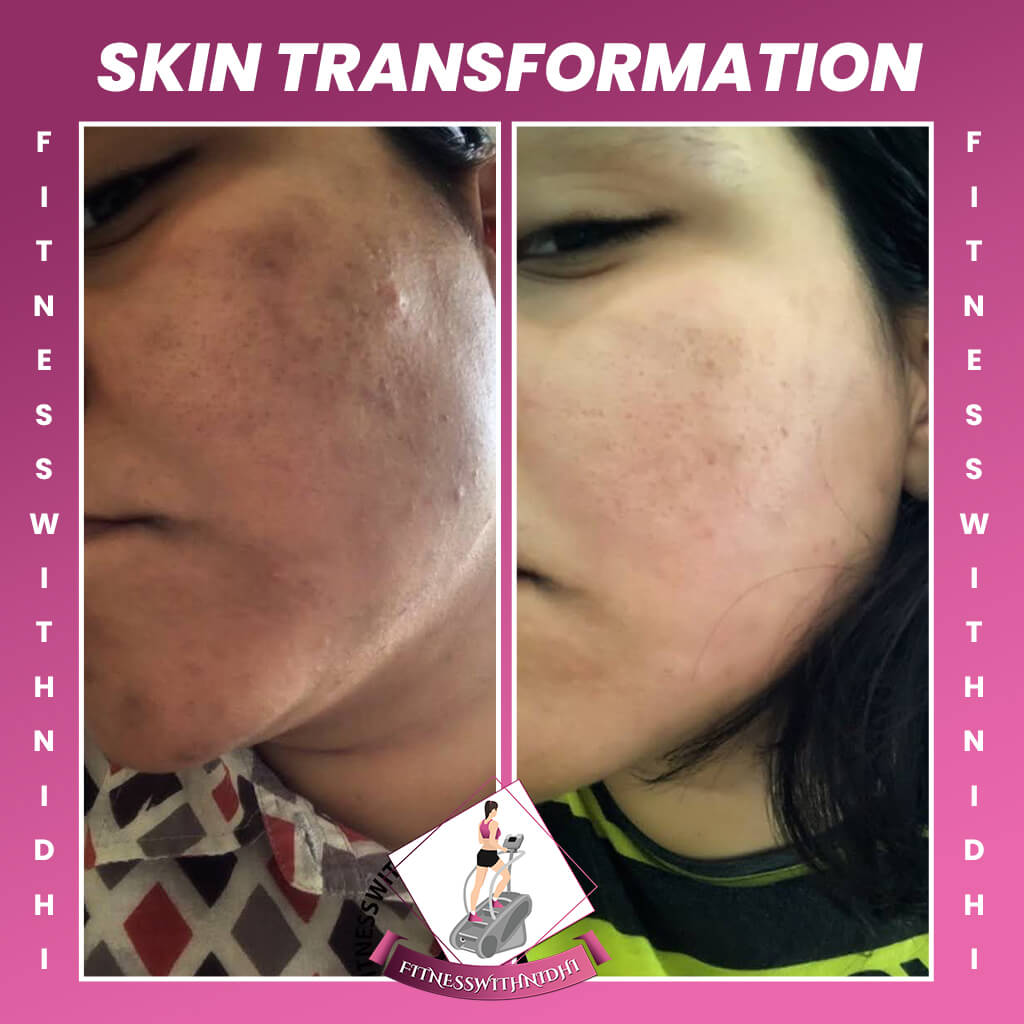 skin transformation of fitness with nidhi client